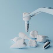 Mini przewodnik po implantach stomatologicznych: wszystko, co musisz wiedzieć
